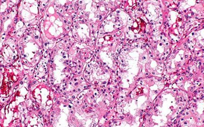 NEWS: Adjuvant Belzutifan Combo Is ‘Practice Changing’ in RCC