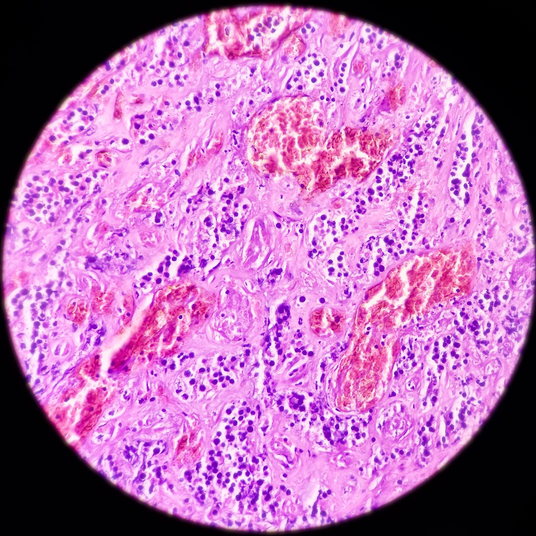 kidney cancer kidney cancer