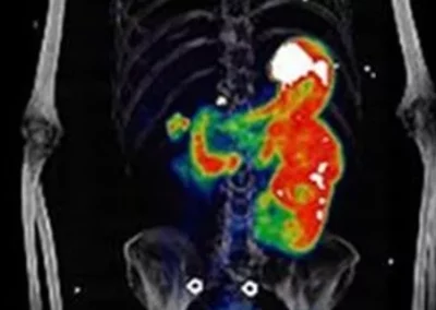 New PET agent offers ‘exceptional’ imaging of kidney cancer